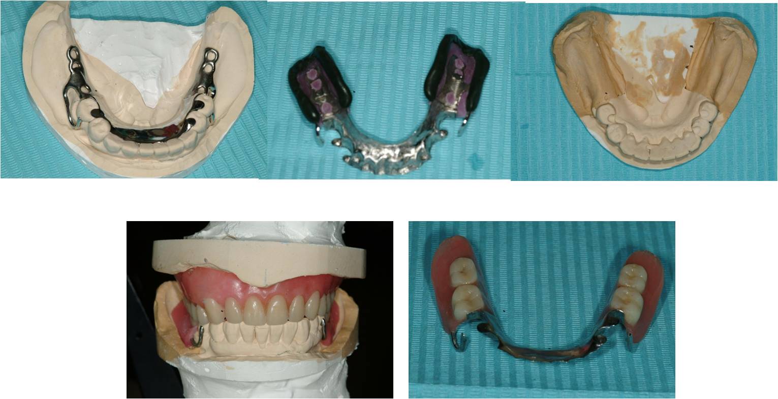 牙 口腔 蛀牙 牙床 牙髓 牙本质 智齿 牙神经 牙科 假牙 拔牙 骨钉 正畸 植入-cg模型免费下载-CG99