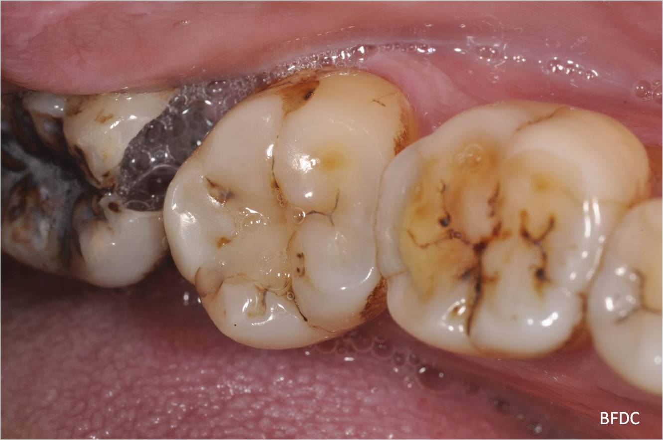 蛀牙怎麼辦？了解蛀牙治療方式與預防方法 - 竹北品粹牙醫